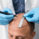 Understanding Hair Transplant Methods: FUT vs. FUE vs. Direct Implantation